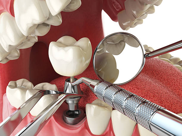 Best Emergency Dentist for Lost Fillings or Crowns in Groveton, VA